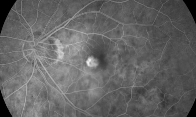 Myopic Choroidal Neovascularization: A Different Disease From AMD