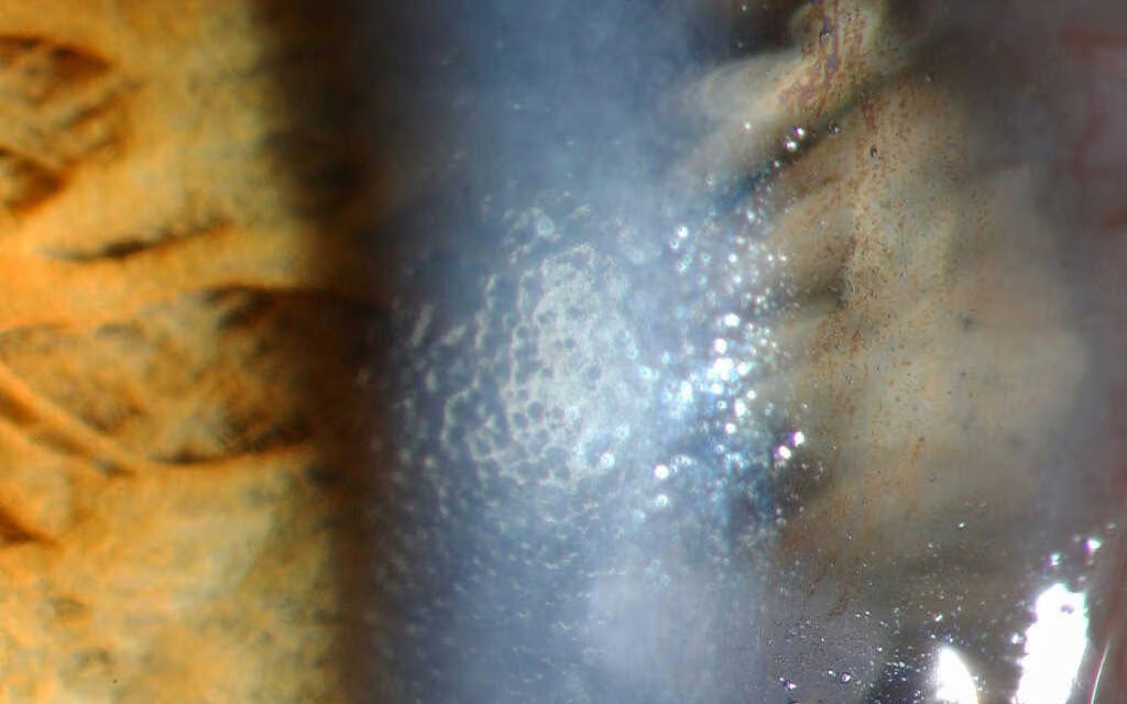 Fuchs Endothelial Corneal Dystrophy: Morning Blur That Clears by Afternoon