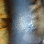 Fuchs Endothelial Corneal Dystrophy