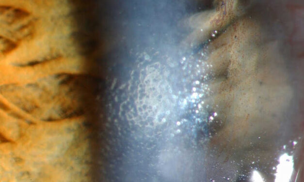 Fuchs Endothelial Corneal Dystrophy: Morning Blur That Clears by Afternoon
