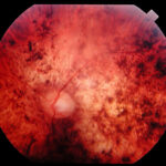 Cone-Rod Dystrophy