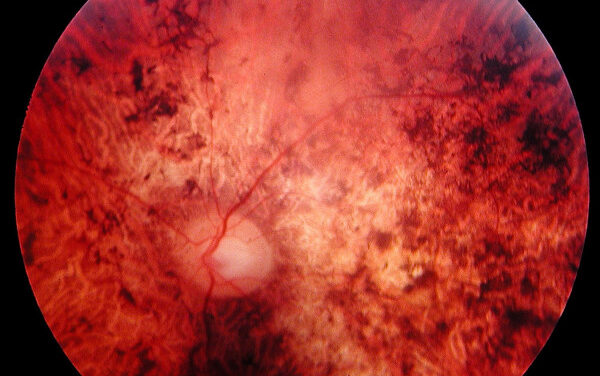 Cone-Rod Dystrophy: The Reverse of Retinitis Pigmentosa’s Order