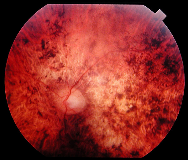 Cone-Rod Dystrophy: The Reverse of Retinitis Pigmentosa’s Order
