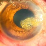 Climatic Droplet Keratopathy