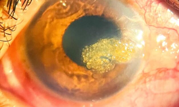 Climatic Droplet Keratopathy: A Corneal Sign of Chronic UV Exposure