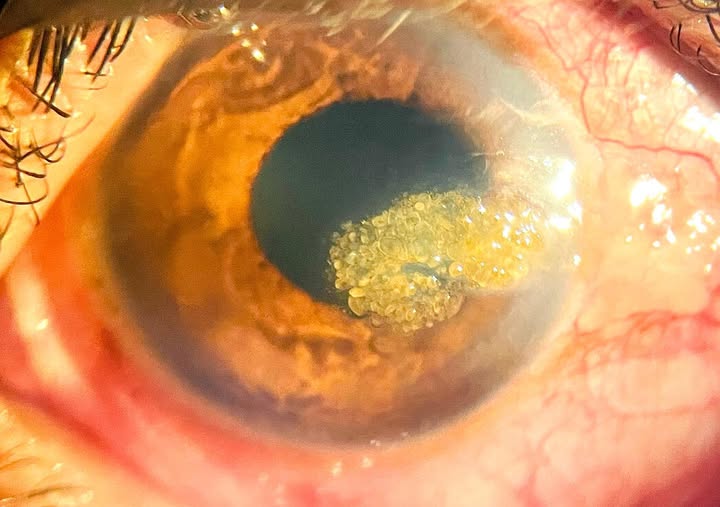 Climatic Droplet Keratopathy