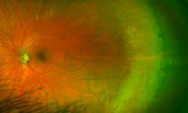 White Without Pressure: A Peripheral Finding That Rarely Means Trouble