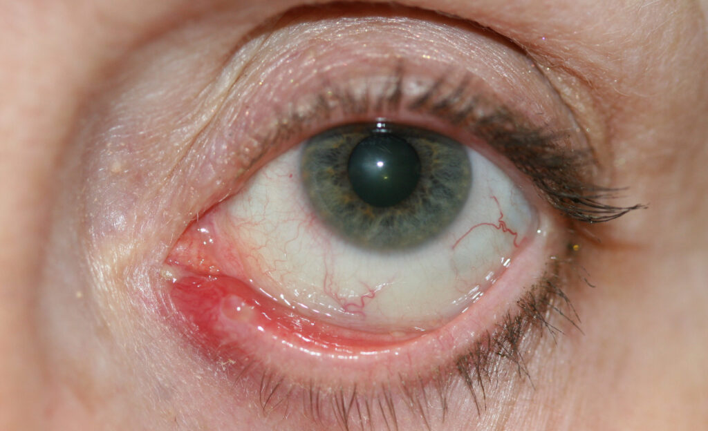 Canaliculitis
