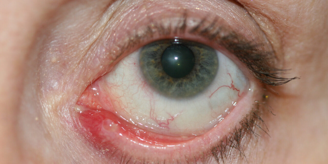 Canaliculitis: The Chronic Conjunctivitis That Won’t Clear