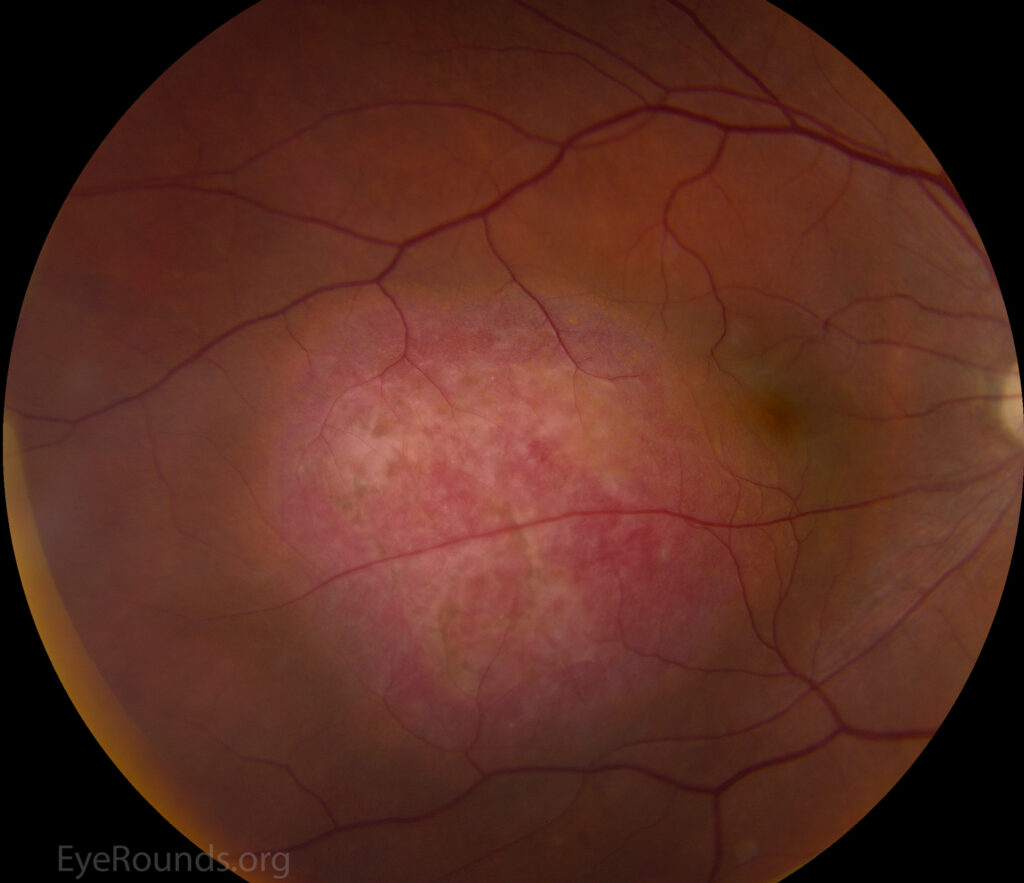 Choroidal Hemangioma