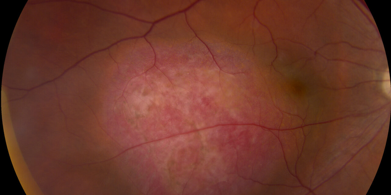 Choroidal Hemangioma: Circumscribed vs. Diffuse