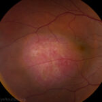 Choroidal Hemangioma