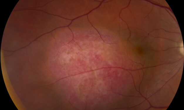 Choroidal Hemangioma: Circumscribed vs. Diffuse