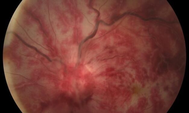 Ophthalmic Artery Occlusion: When the Cherry-Red Spot Disappears Too