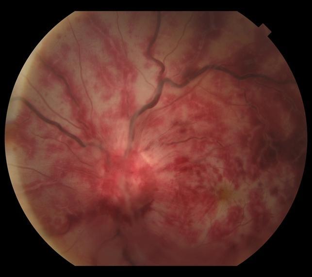 Ophthalmic Artery Occlusion: When the Cherry-Red Spot Disappears Too
