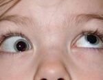 Brown Syndrome