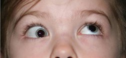 Brown Syndrome: A Restriction, Not a Palsy