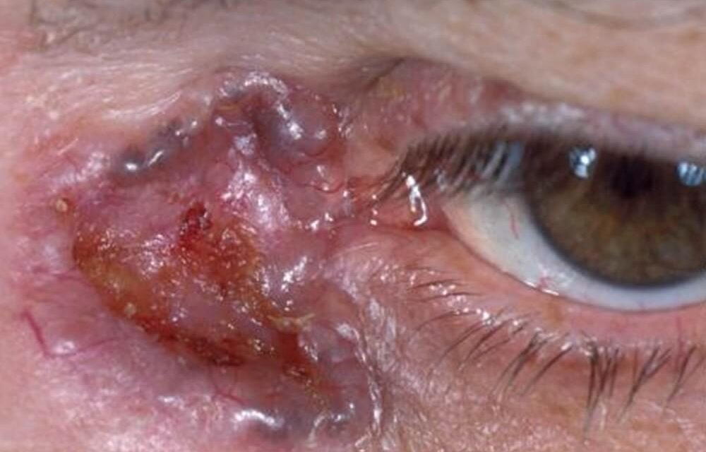 Basal Cell Carcinoma of the Eyelid: Common, Rarely Fatal, Still Serious