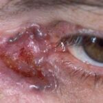 Basal Cell Carcinoma of the Eyelid