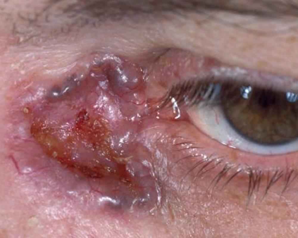 Basal Cell Carcinoma of the Eyelid