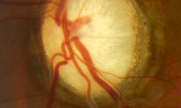 Dominant Optic Atrophy: The Mild Mitochondrial Cousin of LHON