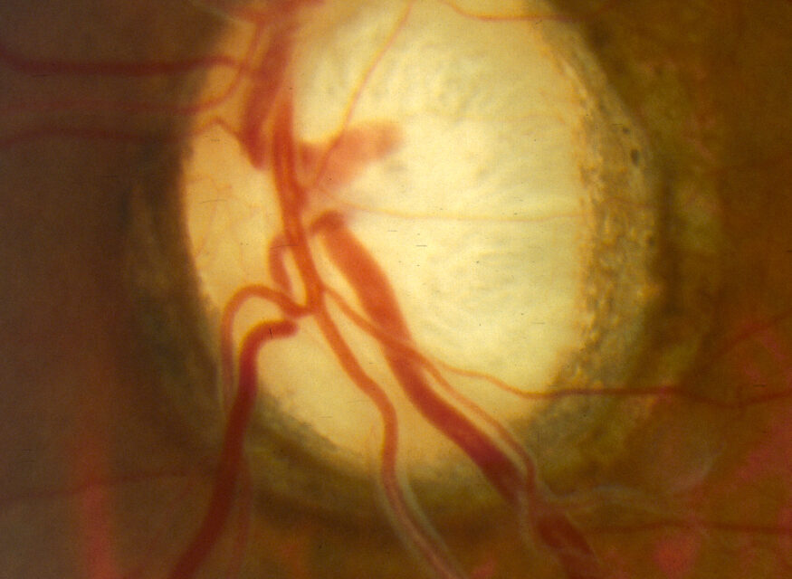 Dominant Optic Atrophy: The Mild Mitochondrial Cousin of LHON