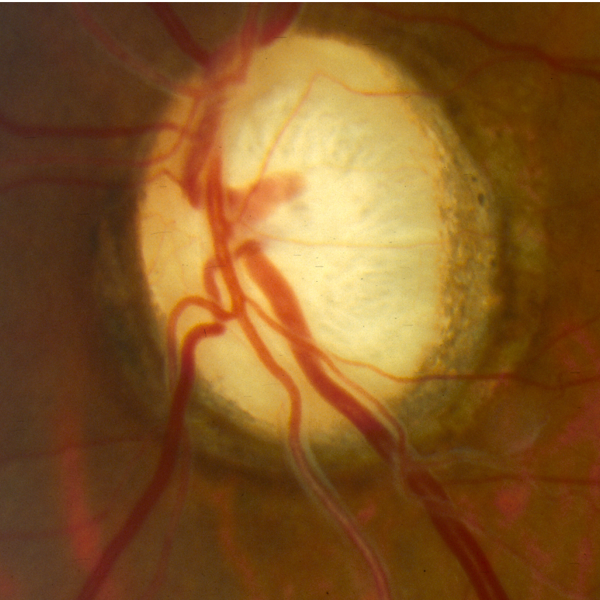 Dominant Optic Atrophy