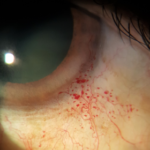 Clinical eye photograph illustrating Ataxia Telangiectasia Ocular Findings