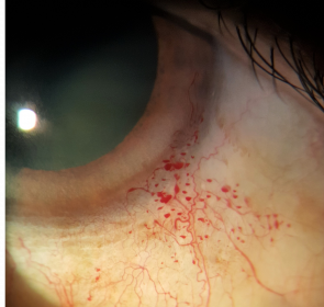 Ocular Findings in Ataxia-Telangiectasia: When Eye Movement Tells the Story