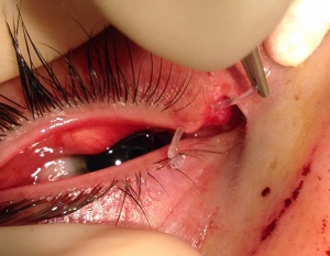 Clinical eye photograph illustrating Canalicular Laceration Repair Technique