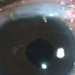 Combined Cataract-Glaucoma Surgery