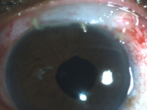 Combined Cataract-Glaucoma Surgery: One Session, Two Problems