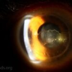 Corneal Graft Rejection