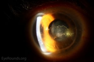 Corneal Graft Rejection: The Four Types and Why Endothelial Rejection Is Different