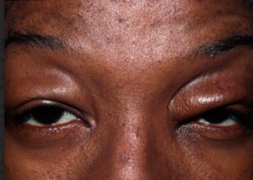 Blepharochalasis: Recurrent Eyelid Swelling That Leaves Its Mark