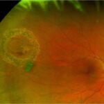 Laser Retinopexy