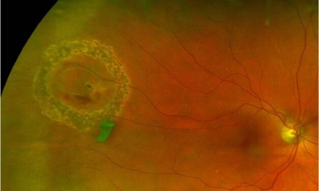 Laser Retinopexy: Sealing a Retinal Break Before It Becomes a Detachment