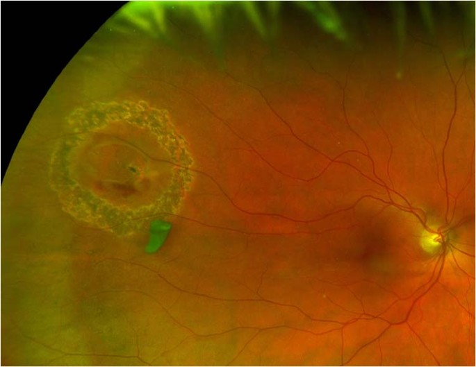 Laser Retinopexy