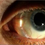 Scleral Buckle Surgery