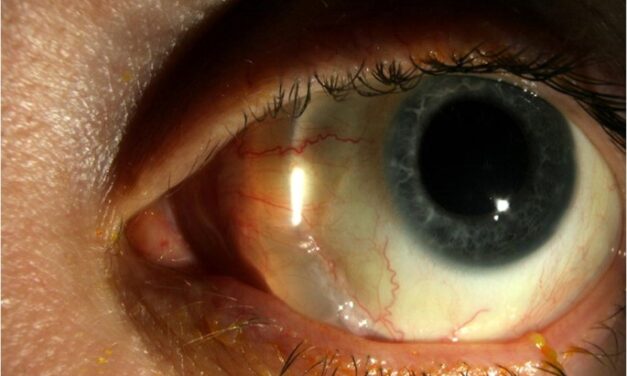 Scleral Buckle Surgery: How an External Approach Still Fixes Retinal Detachment