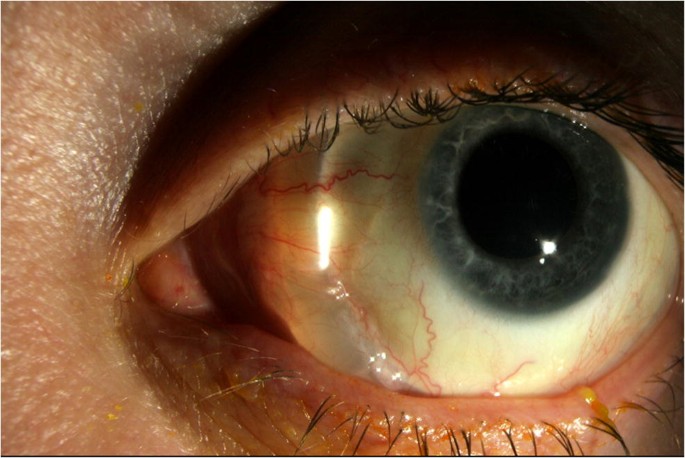 Scleral Buckle Surgery: How an External Approach Still Fixes Retinal Detachment