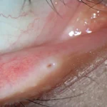 Punctal Stenosis