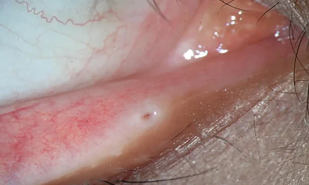 Punctal Stenosis: A Drainage Problem You Can See at the Lid Margin