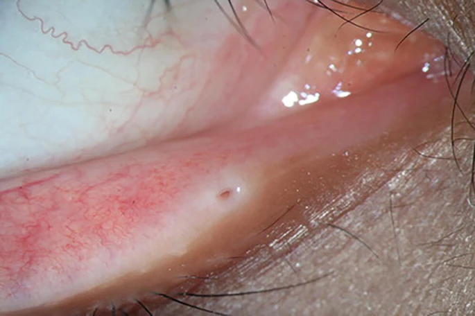 Punctal Stenosis: A Drainage Problem You Can See at the Lid Margin