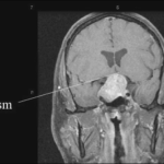 Chiasmal Compression Syndrome