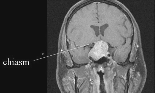 Chiasmal Compression Syndrome: Why Bitemporal Field Loss Points to One Place