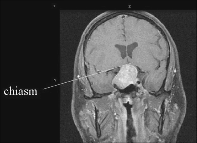 Chiasmal Compression Syndrome: Why Bitemporal Field Loss Points to One Place