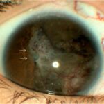 Medulloepithelioma