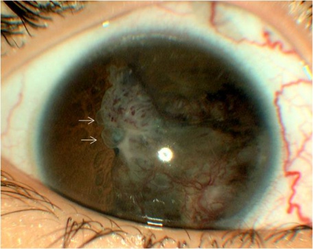 Medulloepithelioma: The Ciliary Body Tumor Hiding Behind the Iris