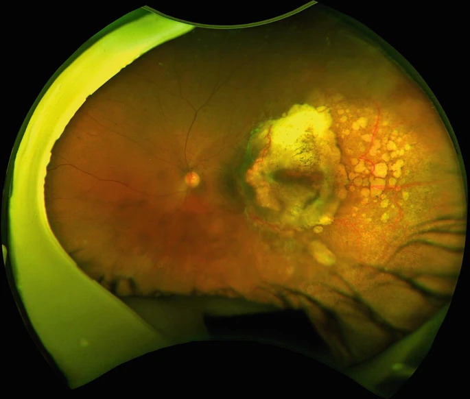 Clinical eye photograph illustrating Cancer Associated Retinopathy Recoverin